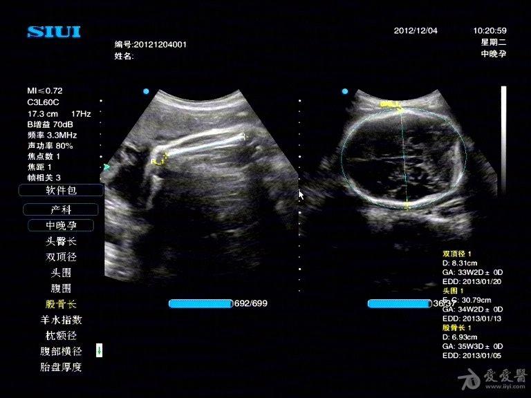 胎儿脊髓圆锥超声图片图片