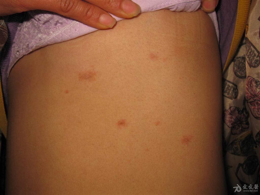 复发性玫瑰糠疹1例