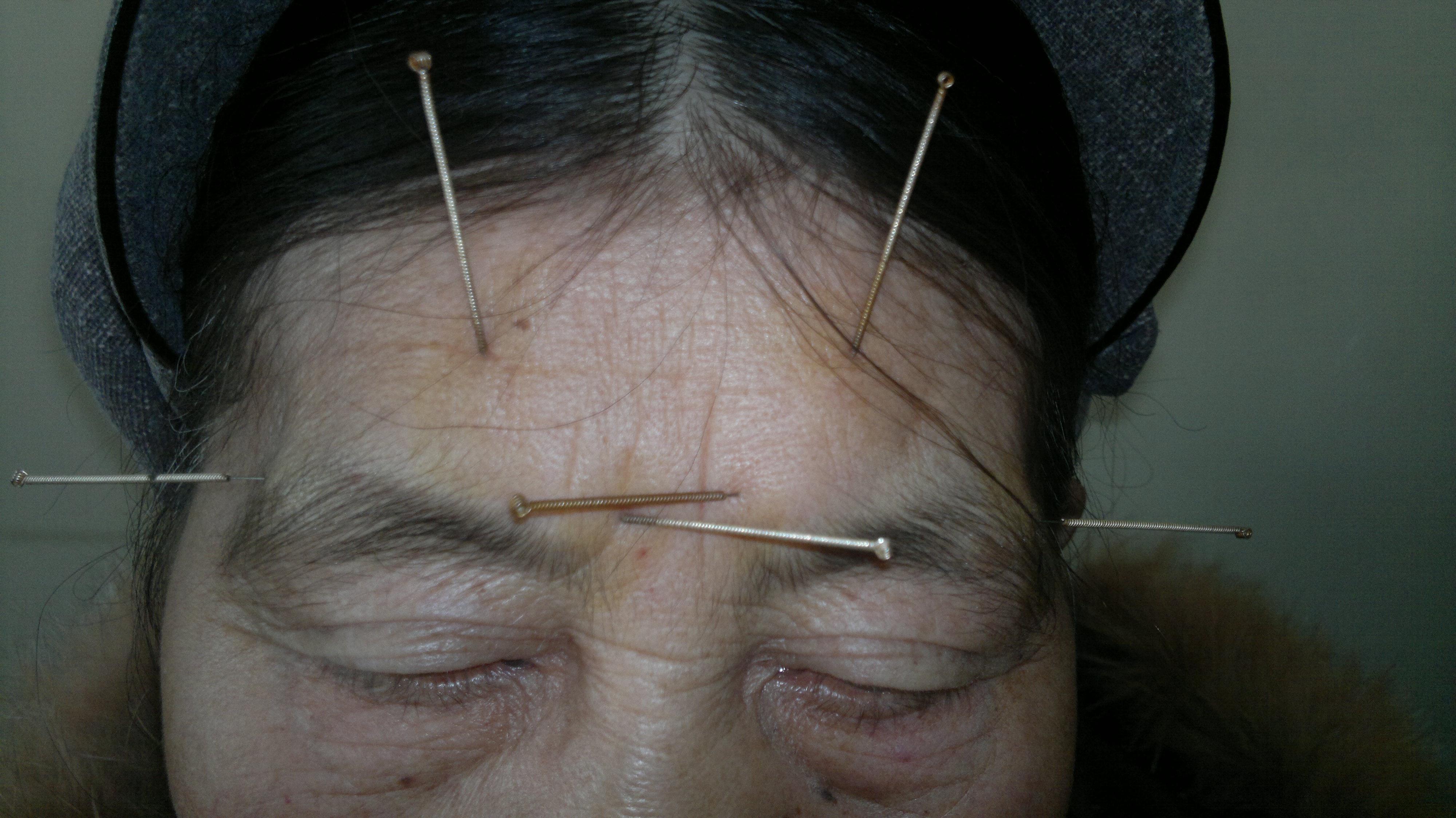 我在基层医院眼科