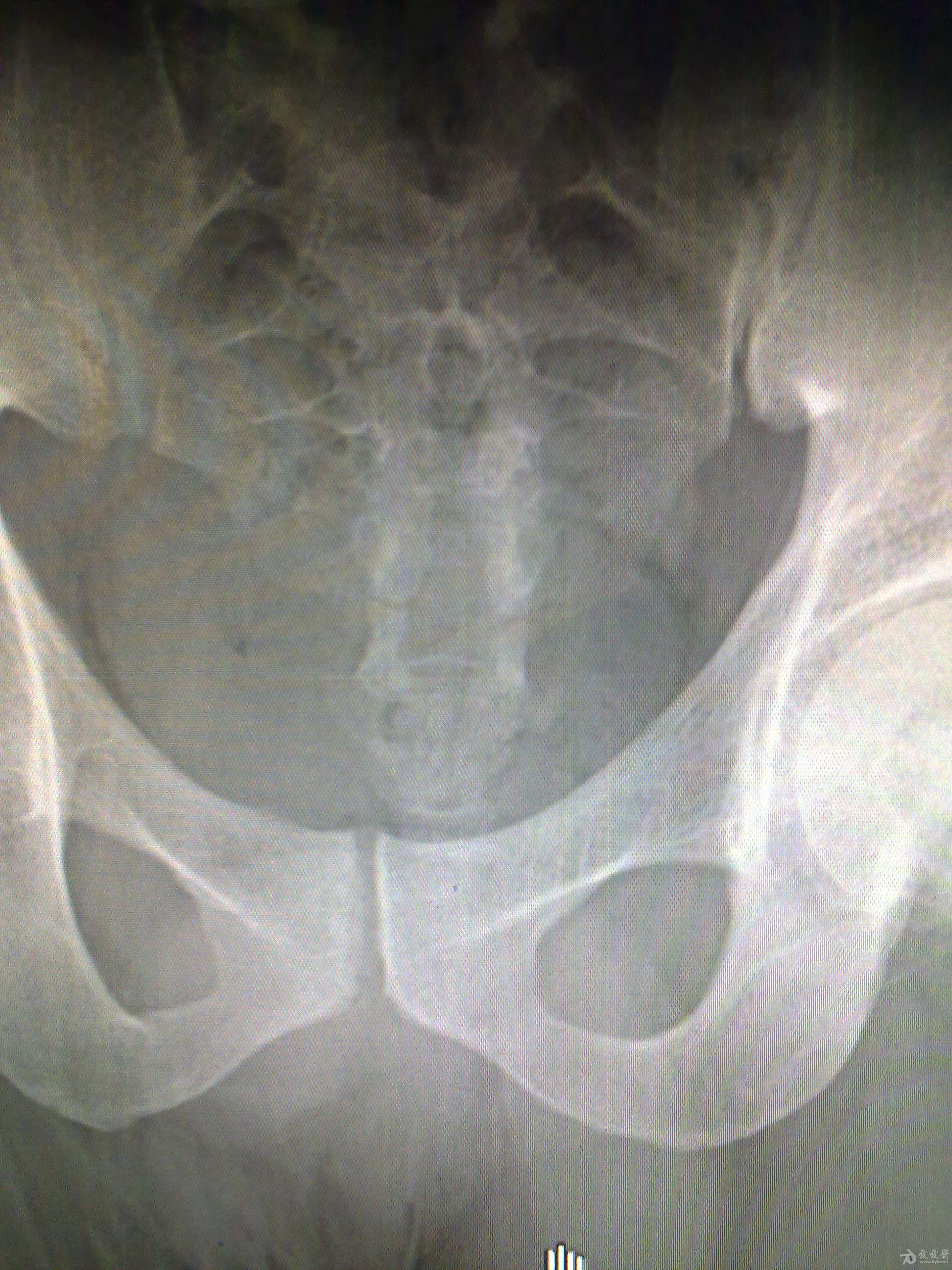 尾脊骨骨折图片