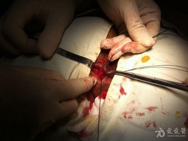 男性结扎手术刀口照片图片