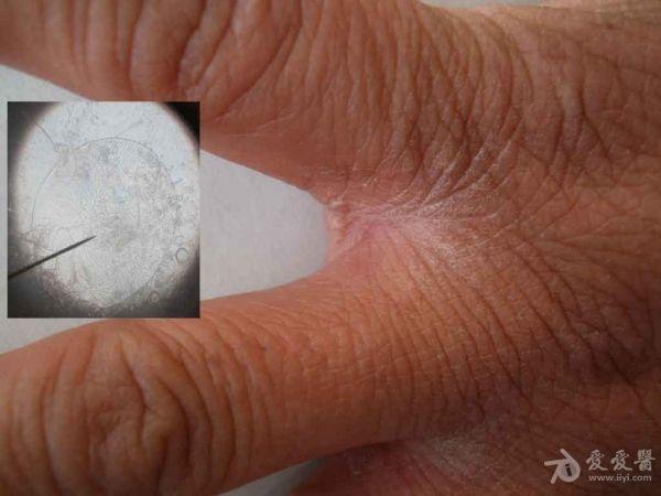 典型病例分享:疥疮及疥虫.