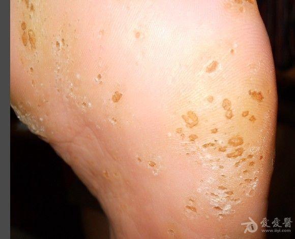 大家看看是什么,疣还是角质硬化