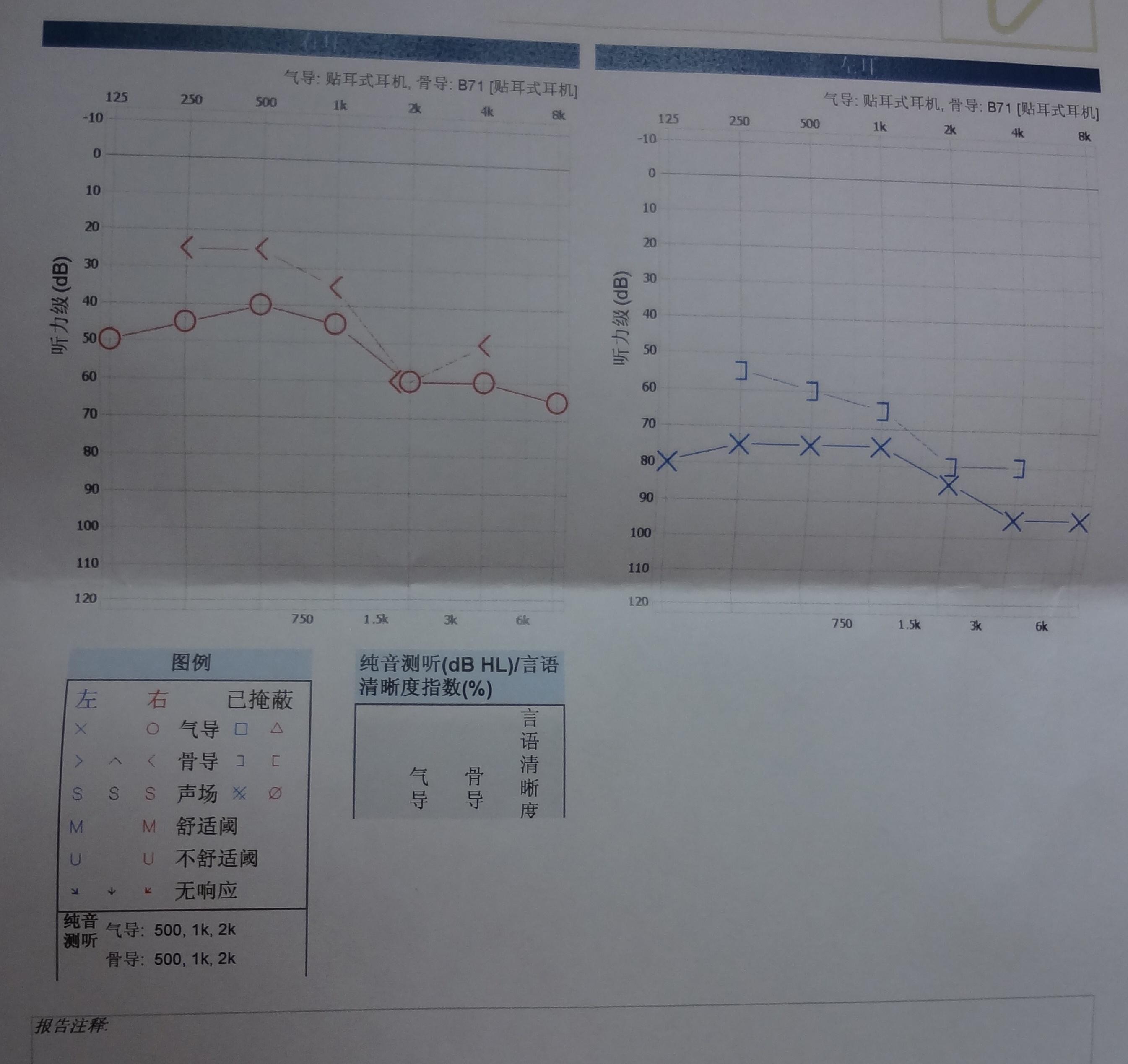 一例神经性耳聋的治疗
