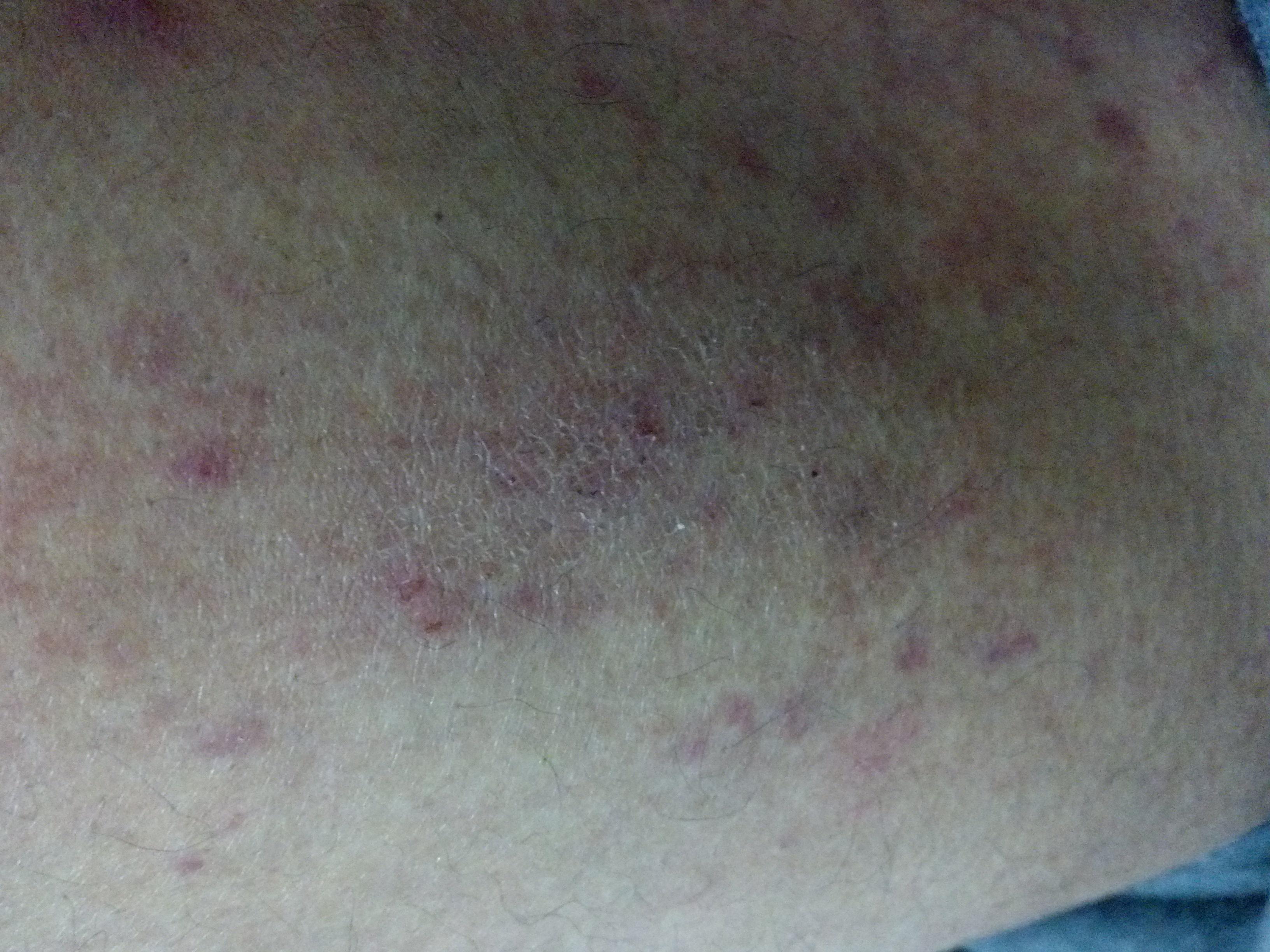 大家看看这是湿疹还是干燥性皮炎?