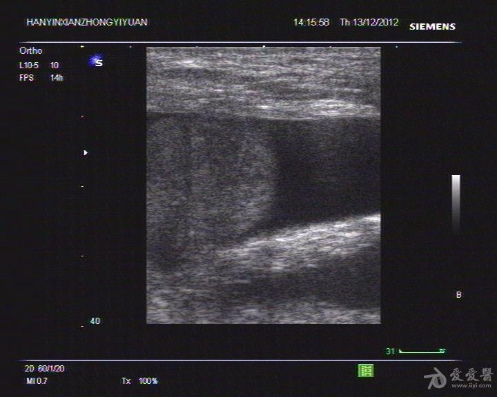 腹股沟疝气超声声像图图片