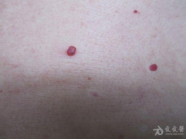 中年男士躯干部的红色丘疹—— 樱桃状血管瘤