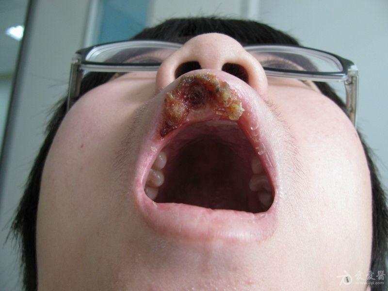 疑难----上唇溃疡