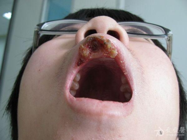 疑难----上唇溃疡