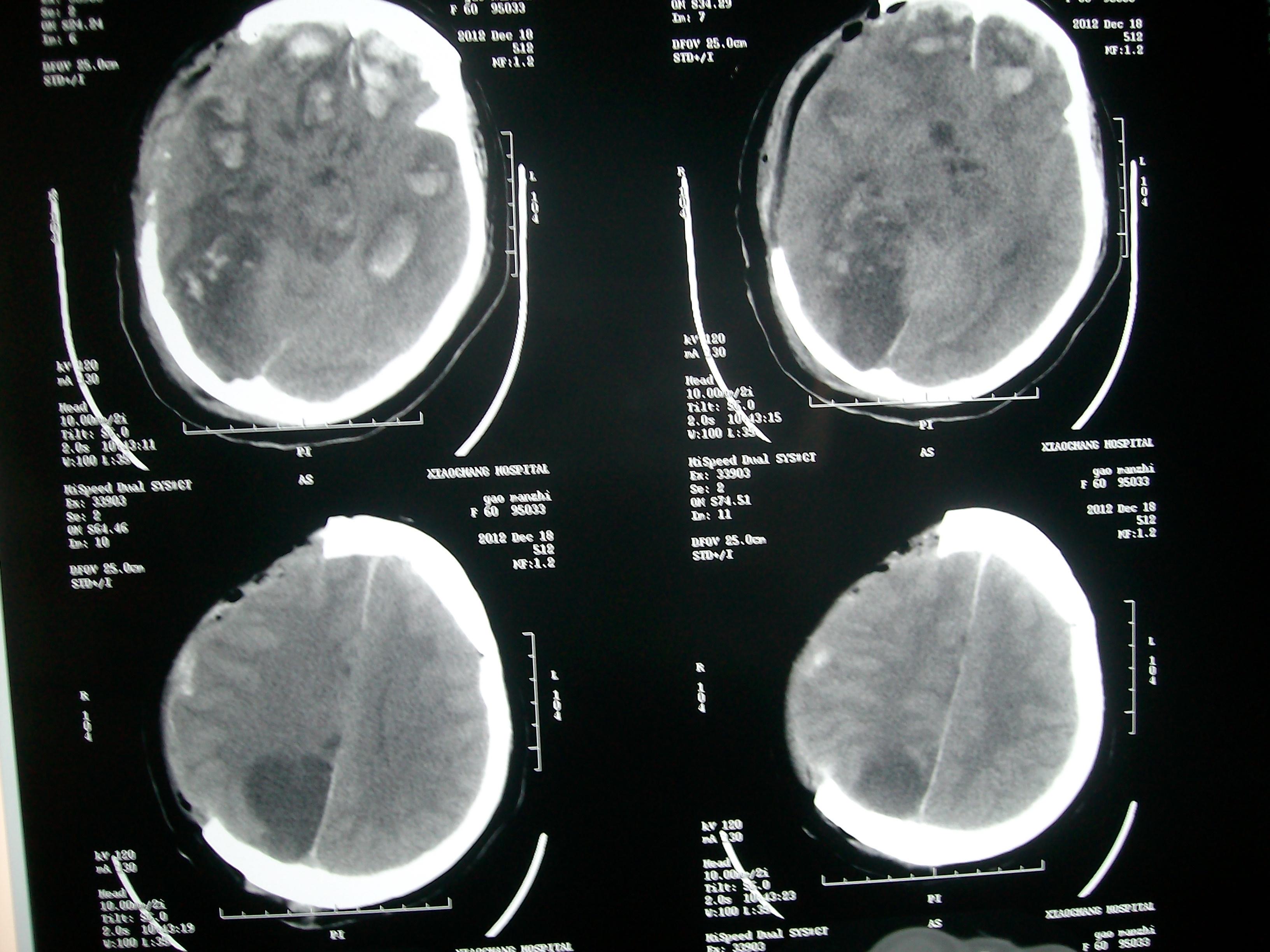重型脑外伤术后1例讨论