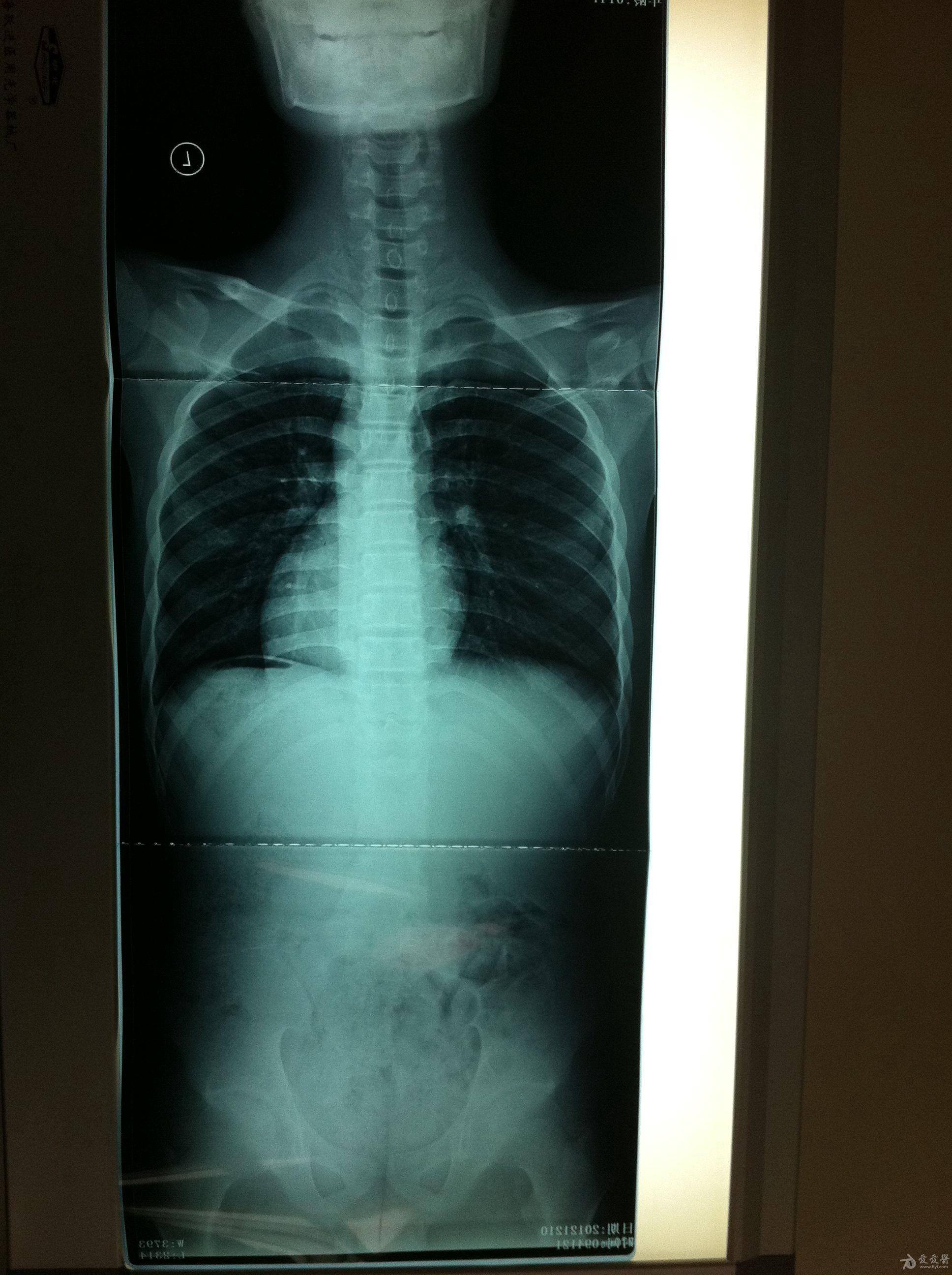 专科检查见脊柱向右侧侧弯畸形,右肩高于左肩呈剃刀背畸形.双下肢感