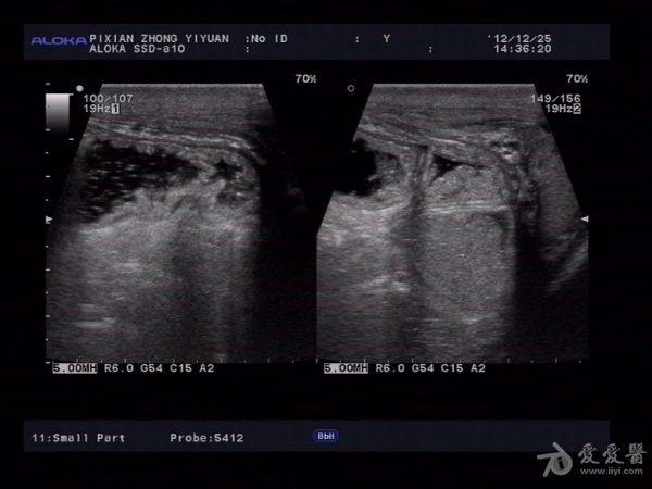 腹股沟疝气超声图像图片