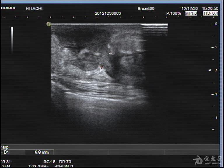 化脓性乳腺炎超声图片图片