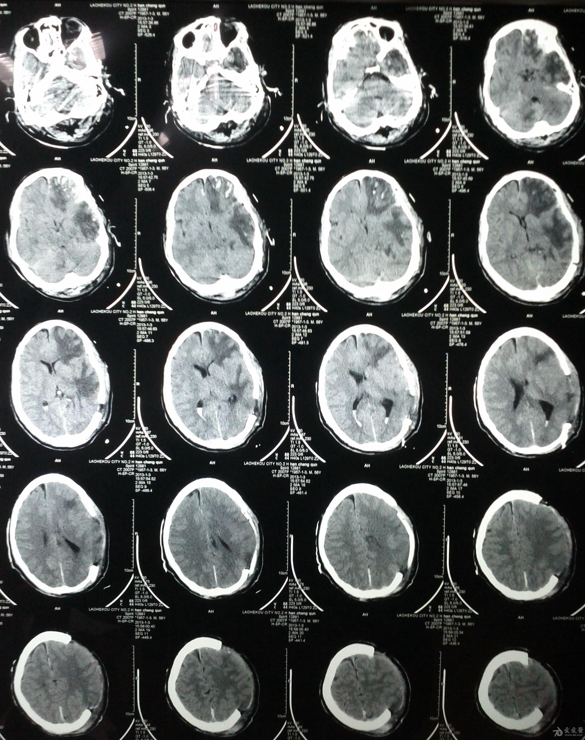 重型颅脑损伤一例