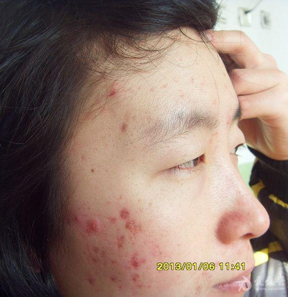 求助此病属何种痤疮?应用中药如何治疗?