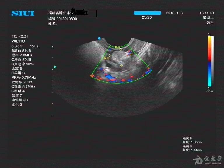 腔內超聲:典型雙子宮,雙宮頸