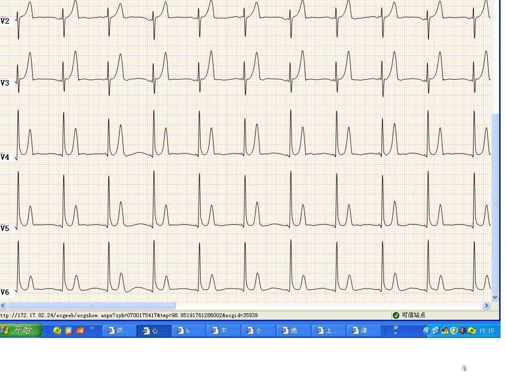 请山羊老师看看,这样的t波是什么情况啊 - 心电图脑电图专业讨论版