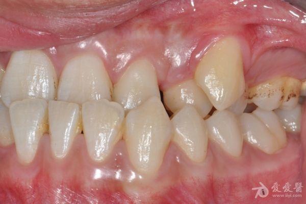 儿童上颌前牙区埋伏多生牙的临床分型与治疗