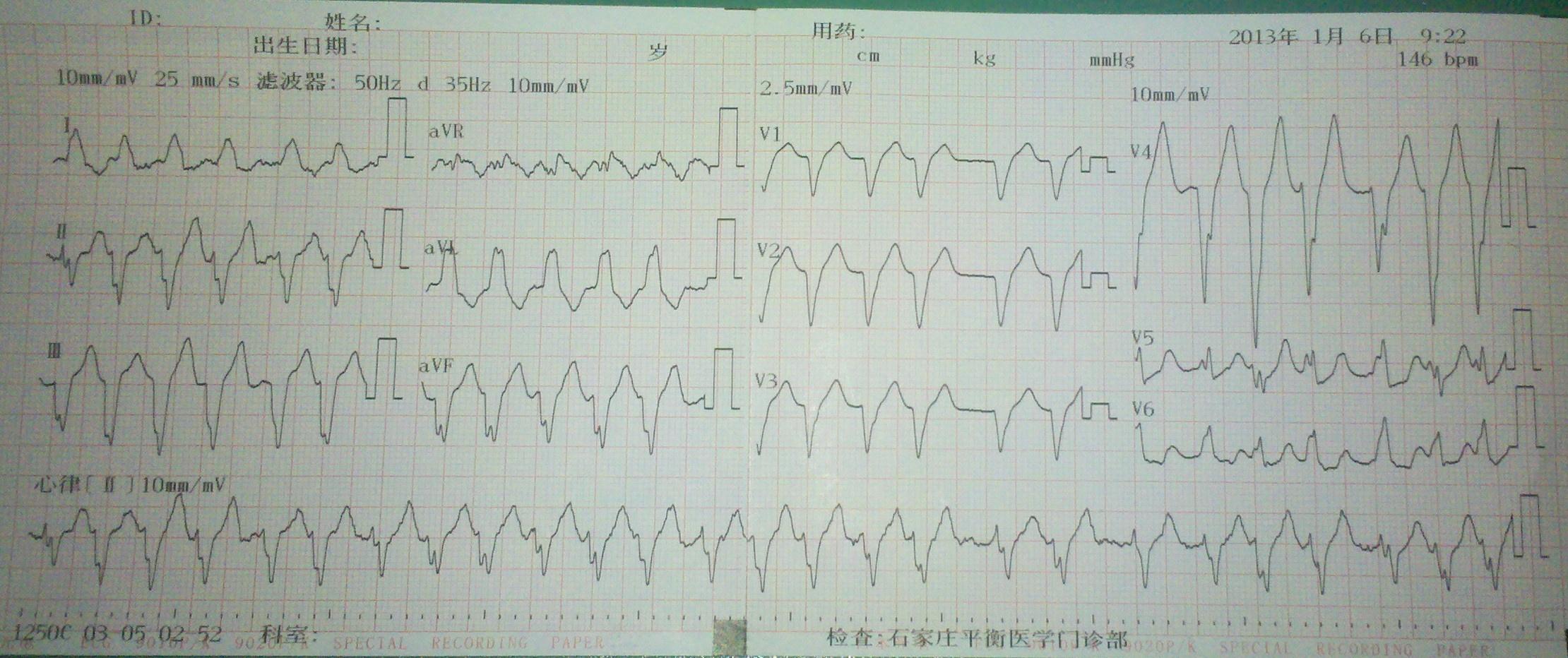 房颤伴完全性左束支阻滞一例 - 心电图脑电图专业讨论版 - 爱爱医医学