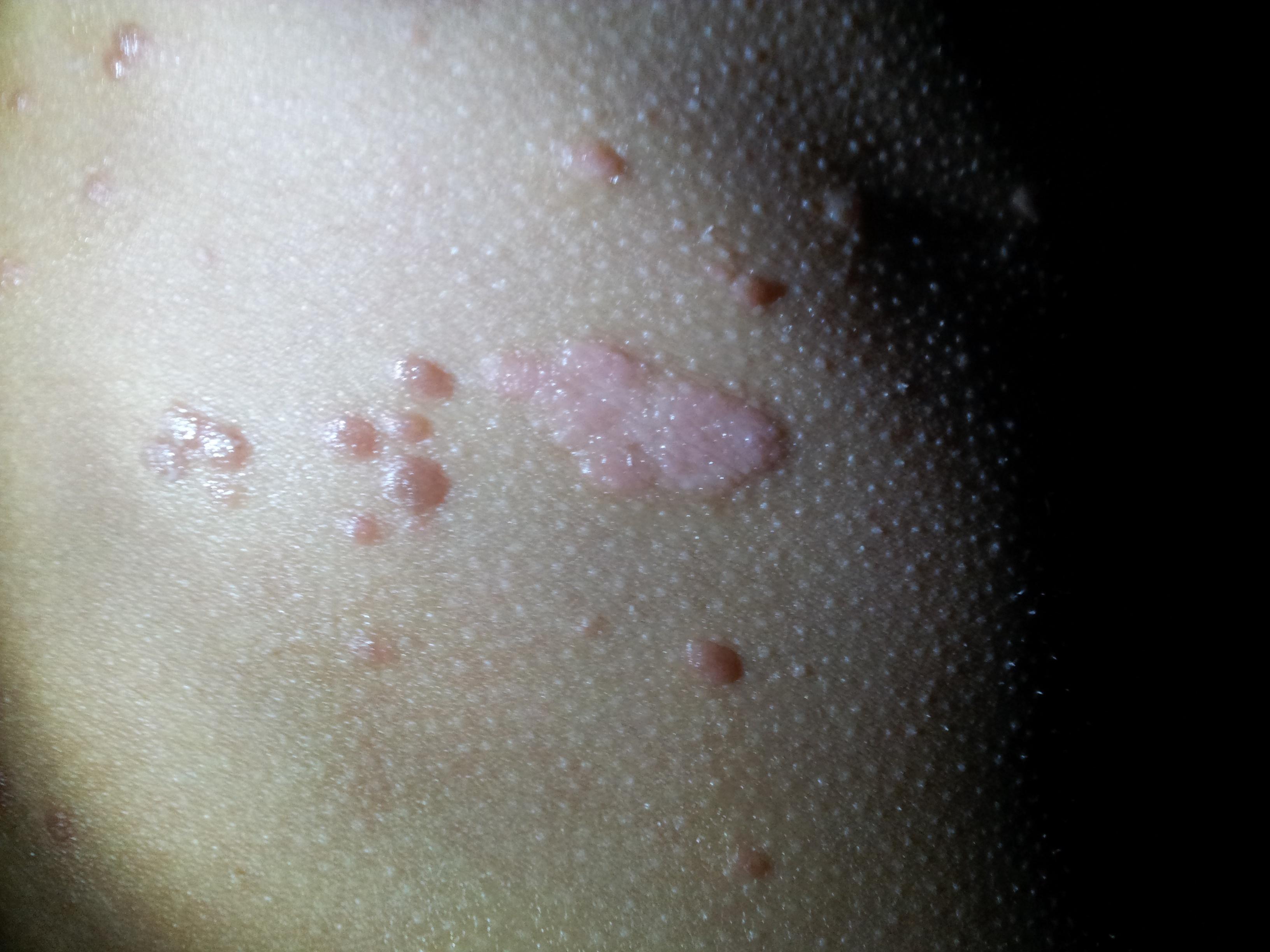 请老师们确诊女儿是银屑病吗?(有照片)