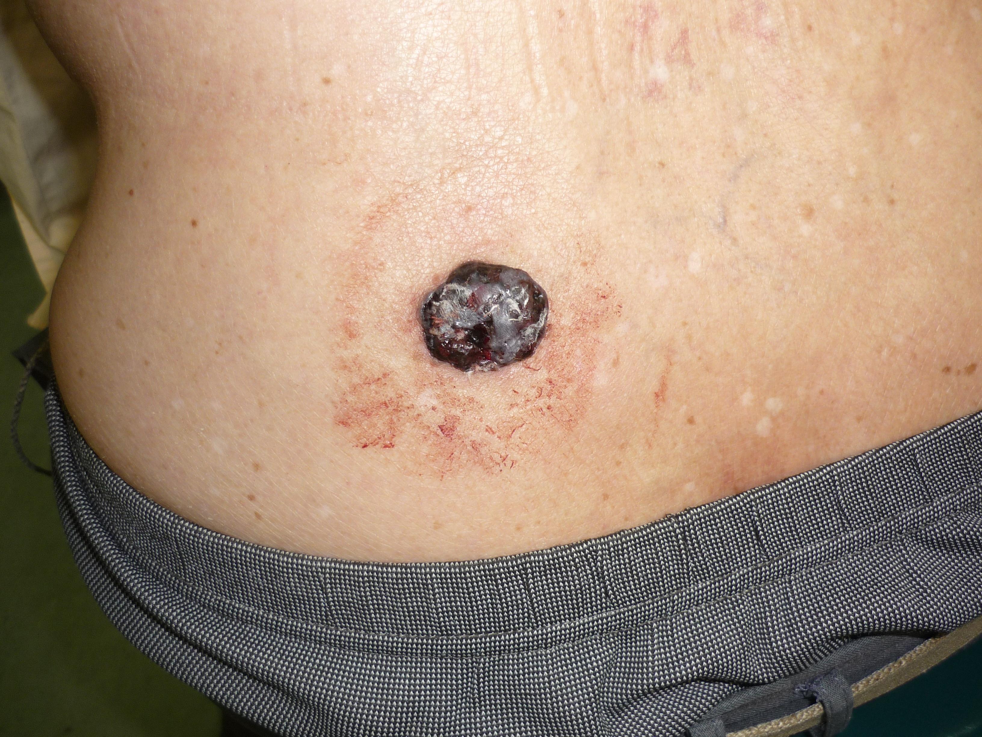 结节性黑色素瘤外观图片