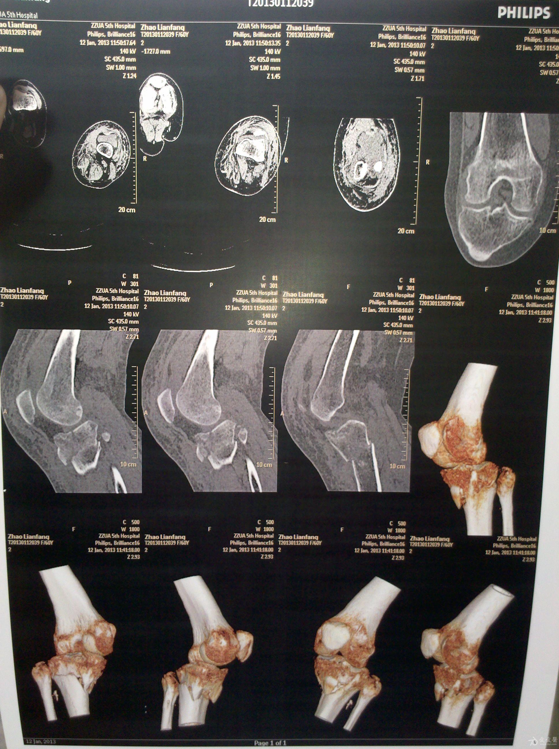 左侧胫骨平台骨折,请看片