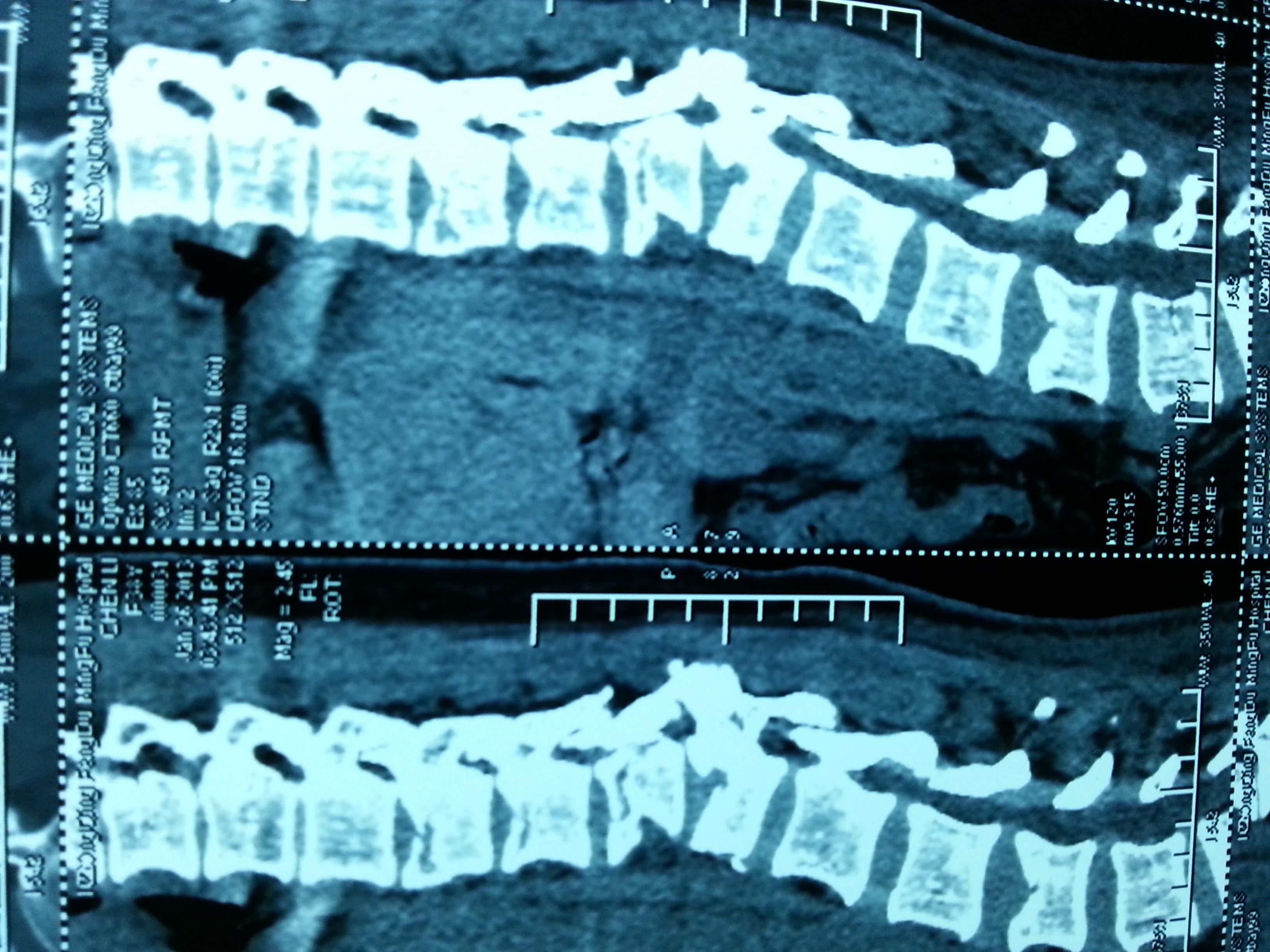 胸椎核磁共振图片图片