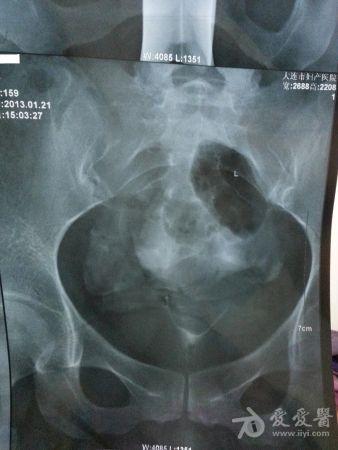 昨天去做了个碘海醇造影,结果是左侧通,右侧不通,纠结是否做腹腔镜