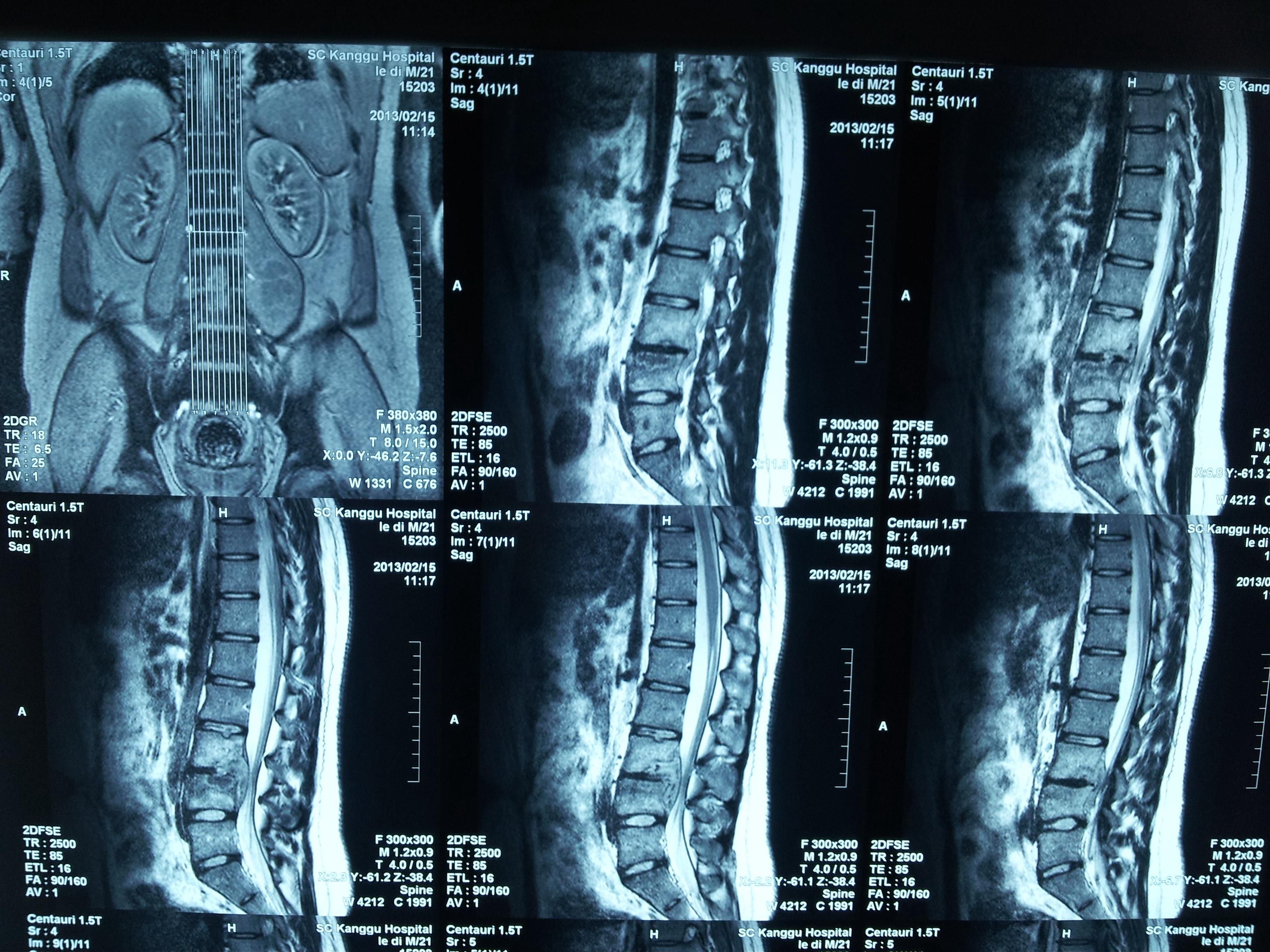 腰大肌脓肿CT图片图片