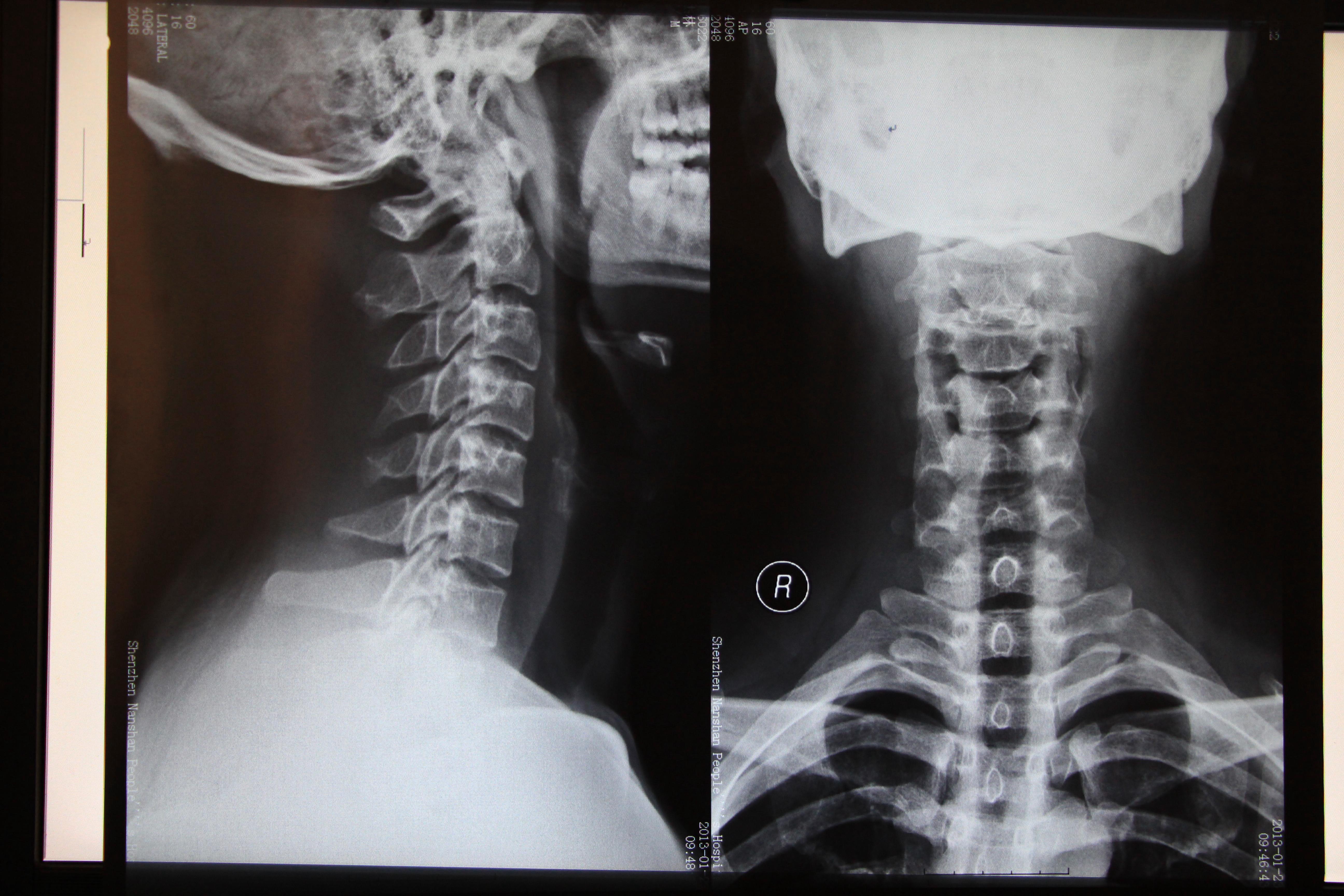 正常人的颈椎x光片图片
