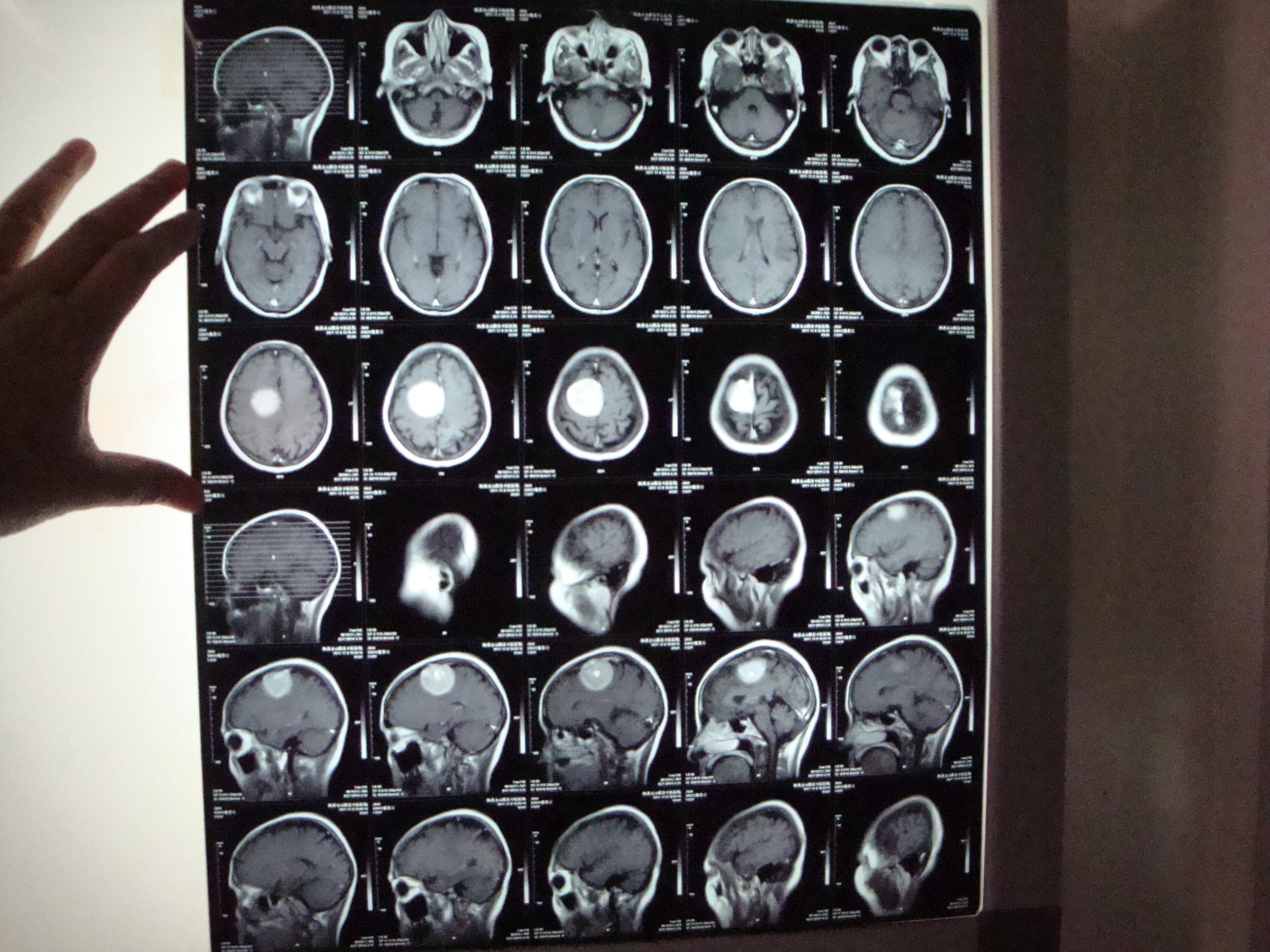 脑瘤ct图图片
