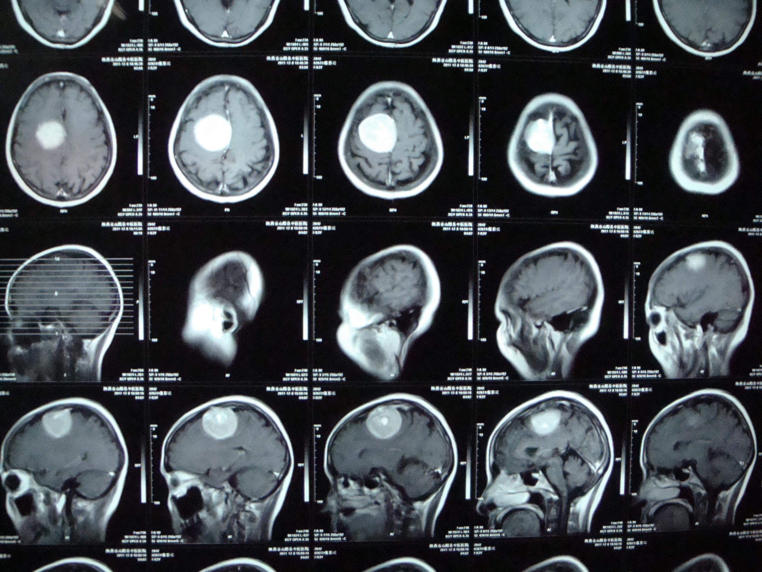 脑瘤x光图片图片