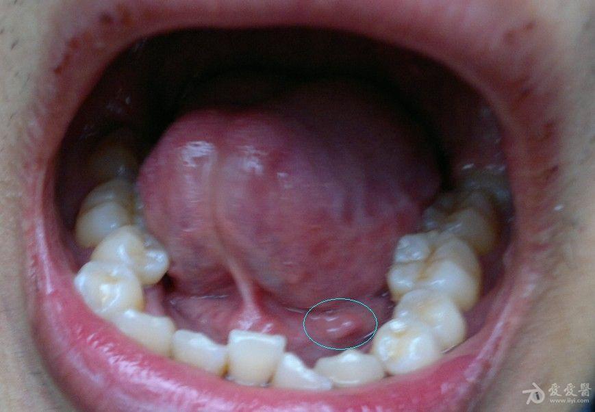 早期口腔扁平疣图片图片