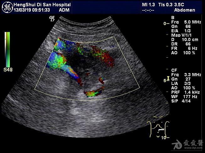 胰腺癌彩超图片