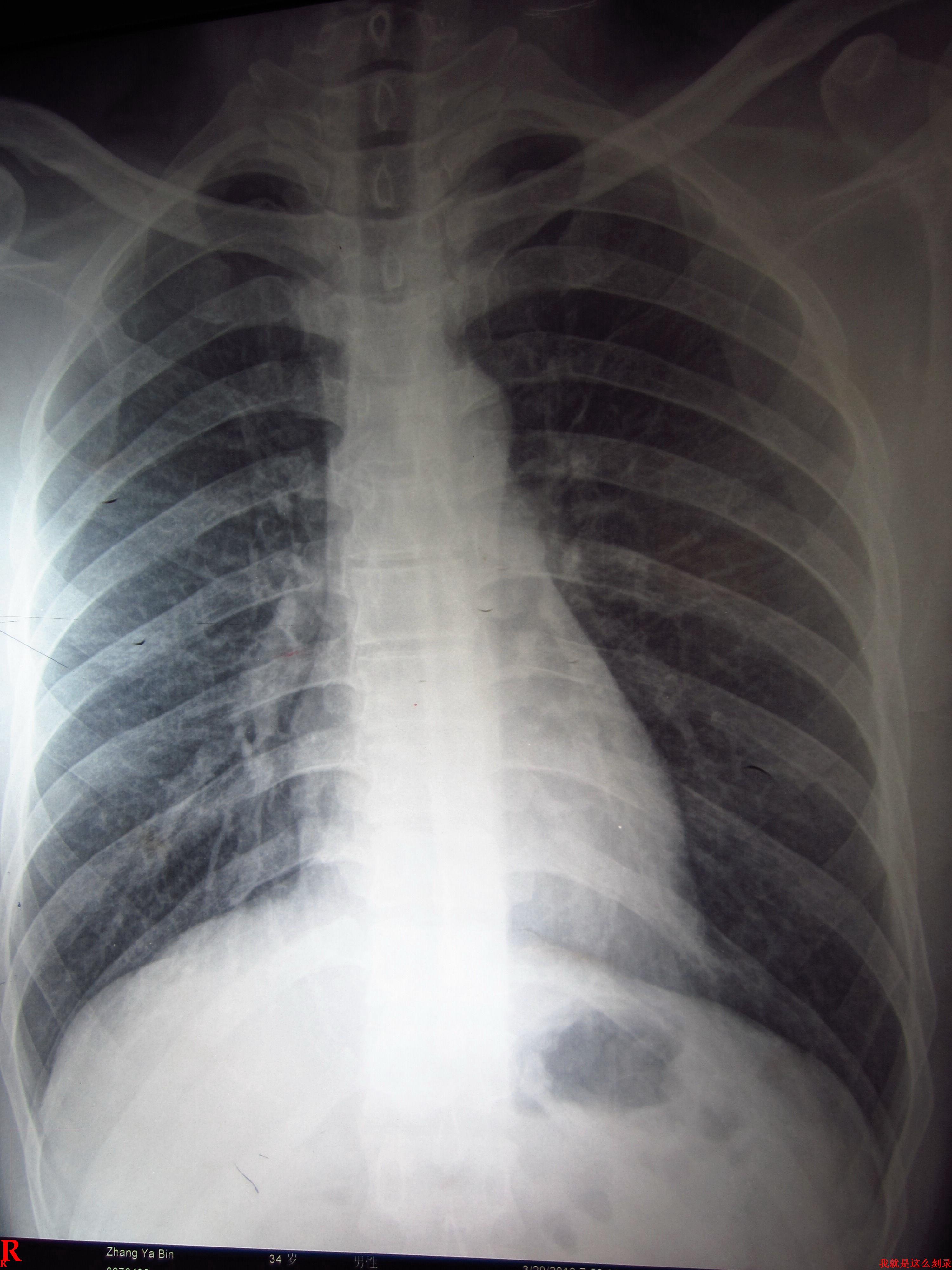 肺部阴影图片胸片图片