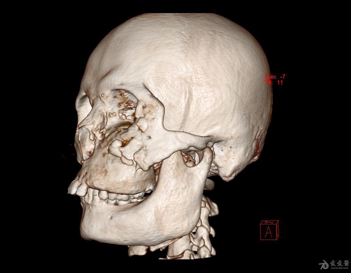 男性头颅ct三维