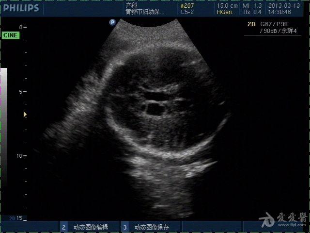 胎儿左侧侧脑室前角内囊样结构,室管膜下囊肿?