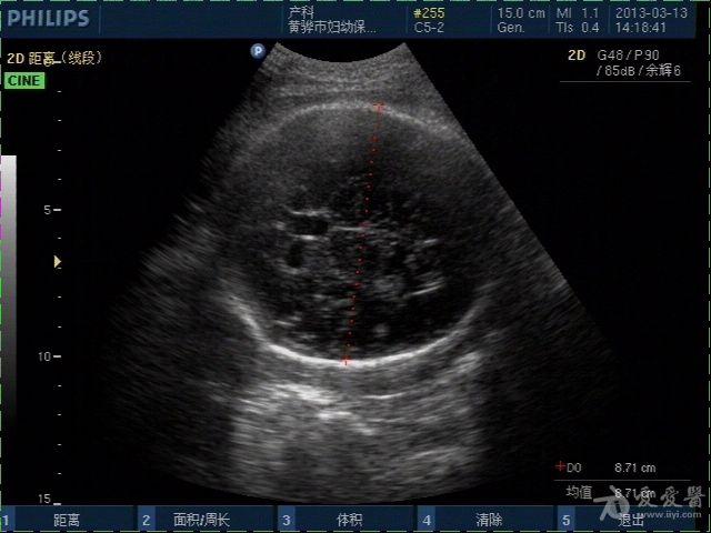 胎儿室管膜图片