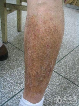 成人腿部干性湿疹图片图片