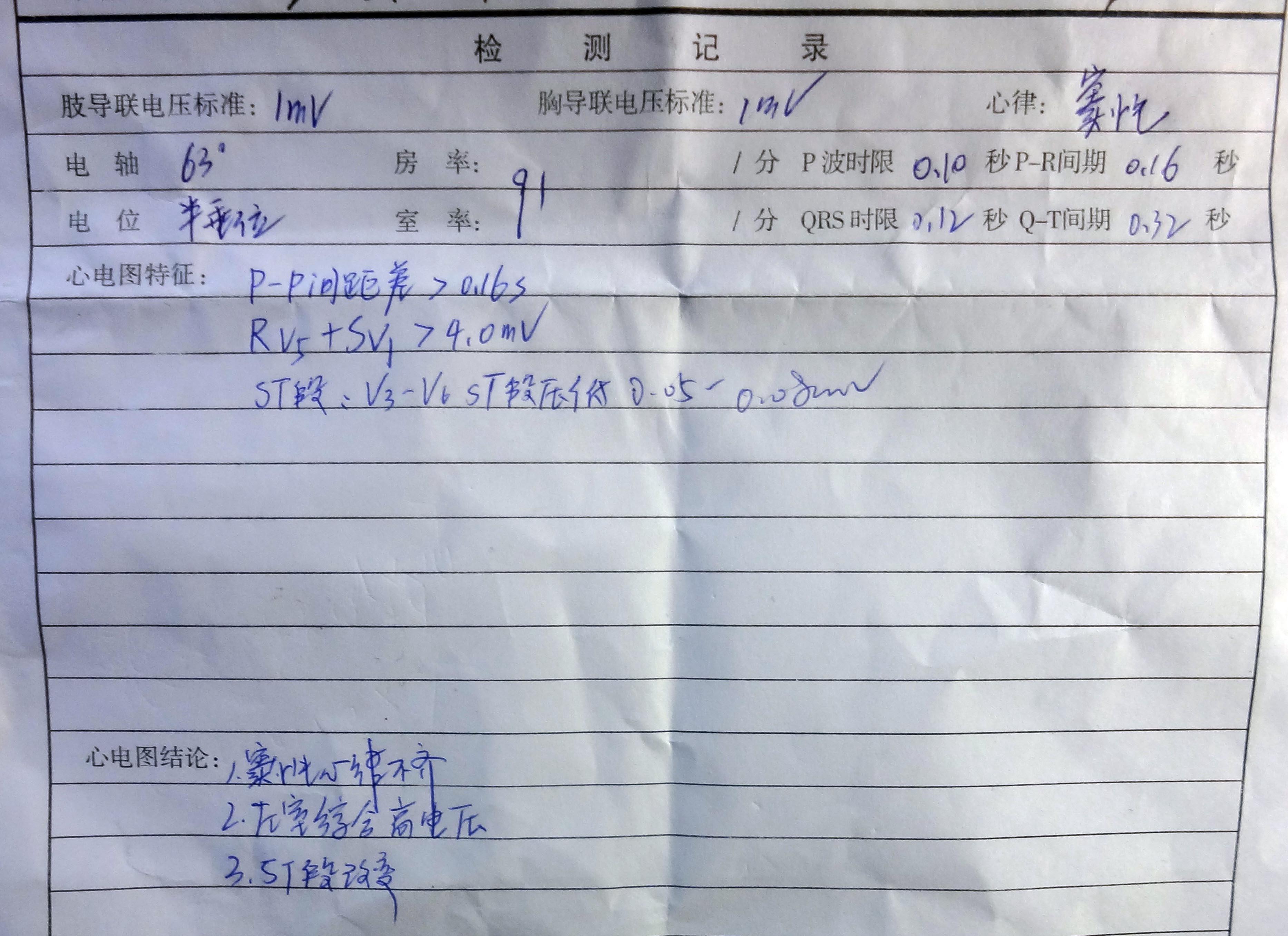 有早搏(一两个月一次),今天去做心电图,结果诊断结果为"p-p间距差>0
