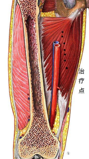 粗针炙针真对大收肌腹按压有结节点及疼痛点透肌剌,下床后走路负重时