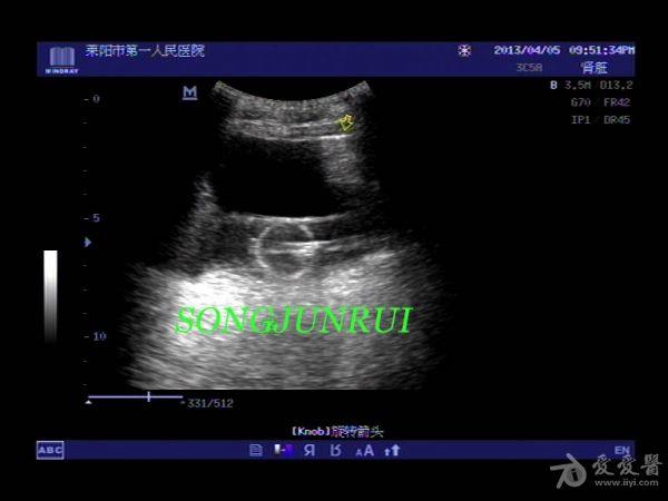 超聲入門貼51-----膀胱破裂