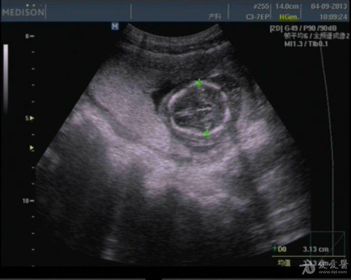 孕3 月,超声显示如下:  子宫内可见胎儿影像,bpd31mm,股骨长径13mm