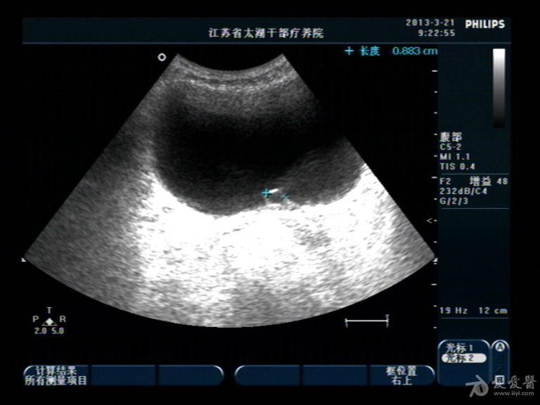 膀胱囊肿超声图片图片