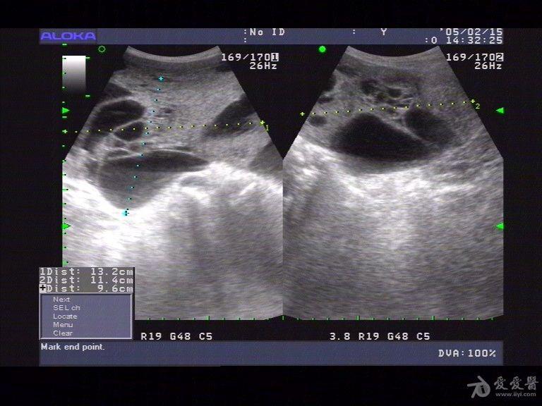 腹腔囊实性占位(卵巢巨大肿瘤?