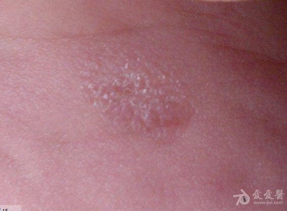 婴儿皮疹——《春季皮肤病病例征集》