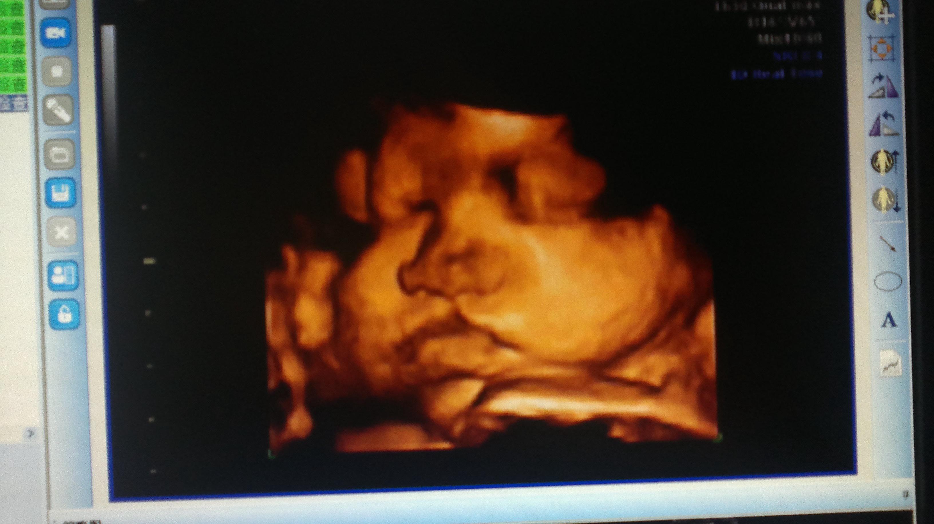 胎儿口角裂四维图片图片