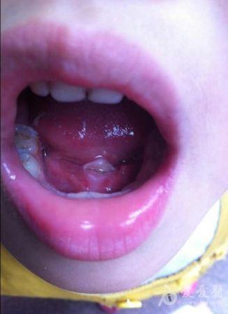 宝宝舌系带溃疡图片