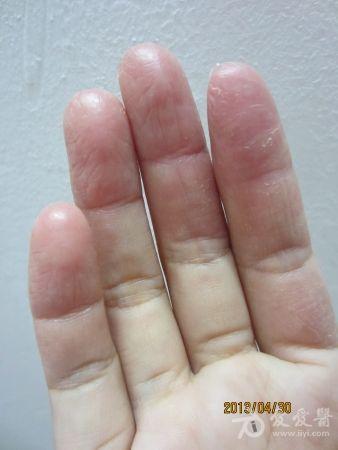 手指真菌脱皮开裂痒图图片