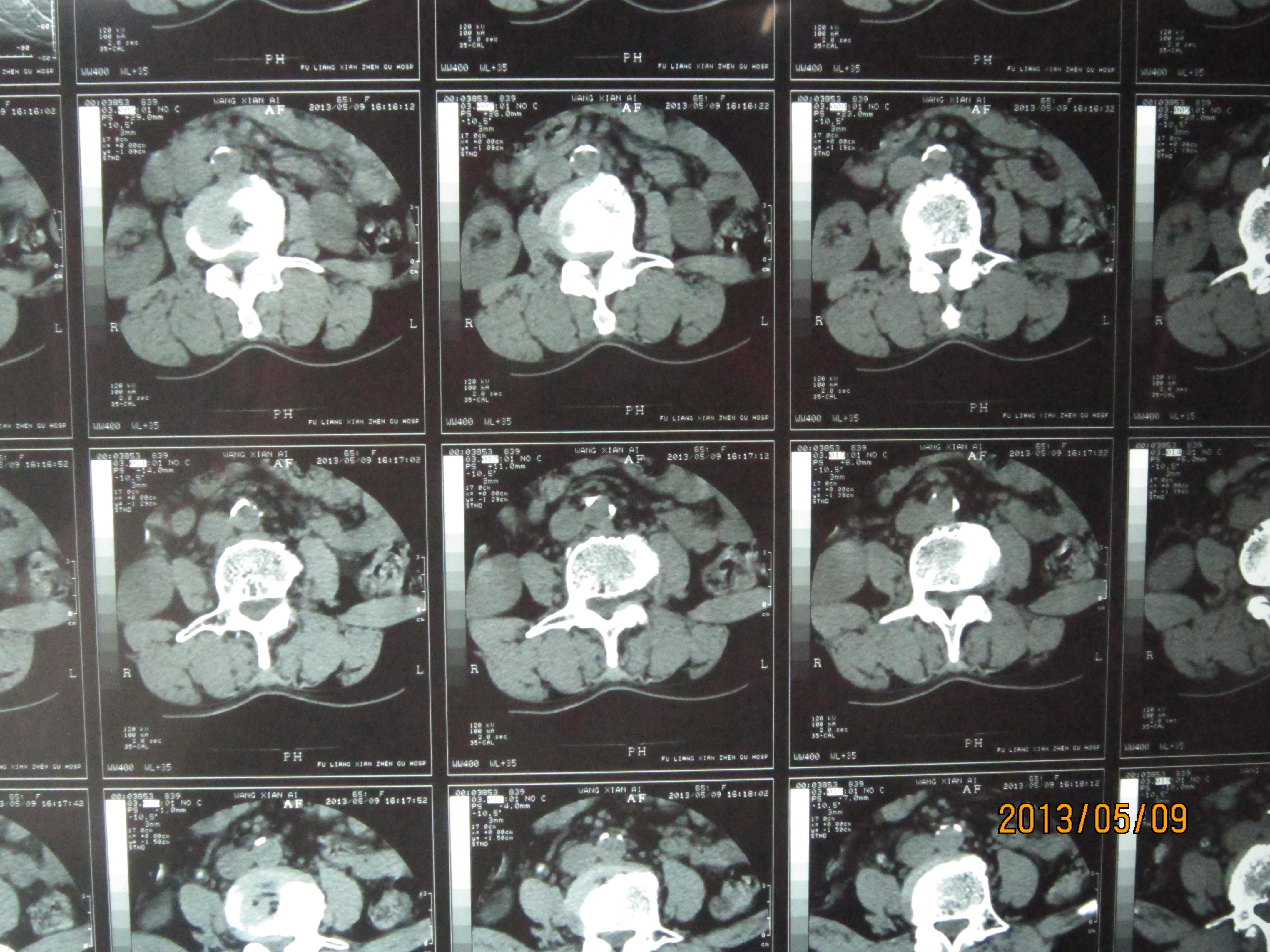 65岁,因腰痛伴左下疼痛20天来就诊,予以行腰椎ct检查,发现靠近椎体